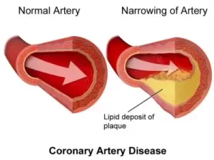 Atherosclerosis narrowing artery e1645632838802 jpg webp